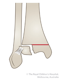 Figure 2 TILLAUX FRACTURE